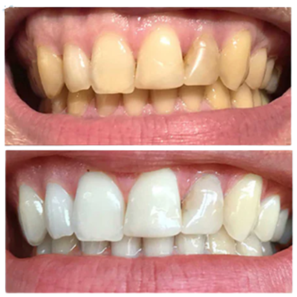 Kit de blanqueamiento dental profesional-sistema luz led integrado  y vitamina E- 🔥HOY CON 50 DCTO